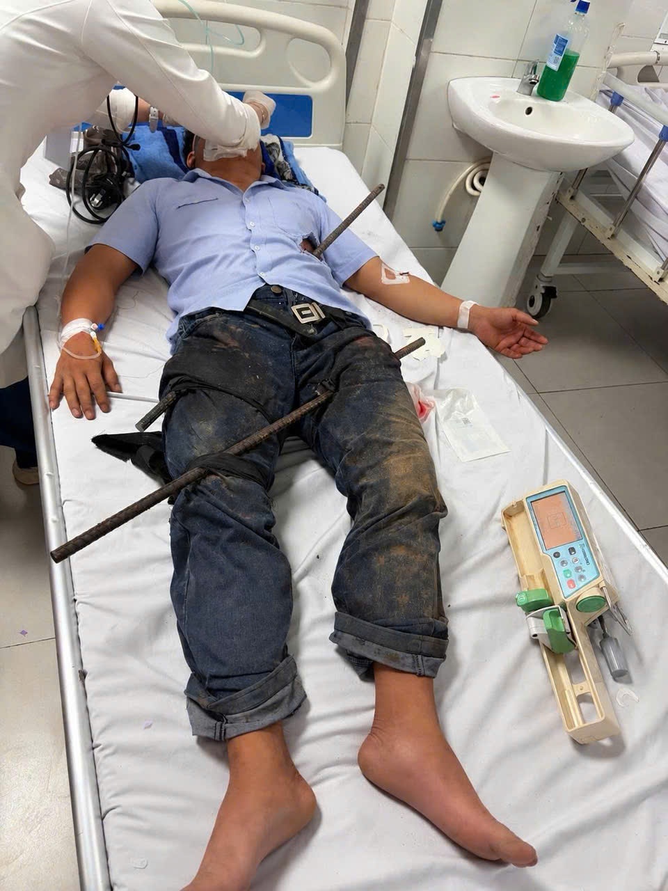 Cứu sống bệnh nhân bị 2 thanh sắt xuyên qua bụng và 2 đùi Cứu sống bệnh nhân bị 2 thanh sắt xuyên qua bụng và 2 đùi