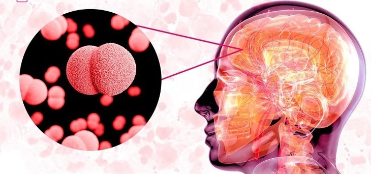 Bệnh viêm não mô cầu: Phát hiện sớm, điều trị kịp thời để hạn chế tử vong