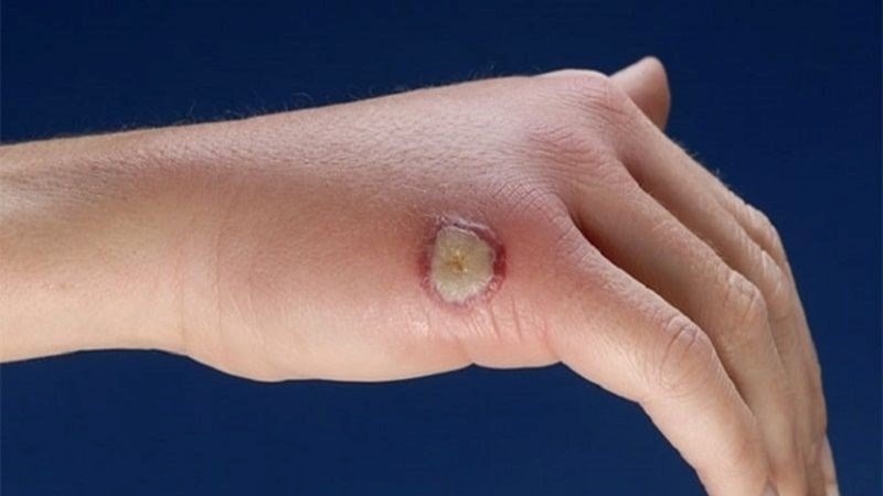 Vi khuẩn gây nhiễm trùng da tạo thành các vết loét Vi khuẩn gây nhiễm trùng da tạo thành các vết loét