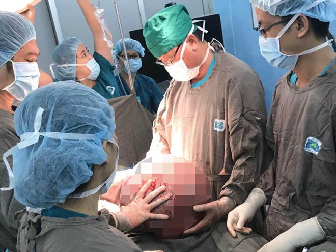 Cắt bỏ thành công khối u buồng trứng khổng lồ nặng hơn 20 kg