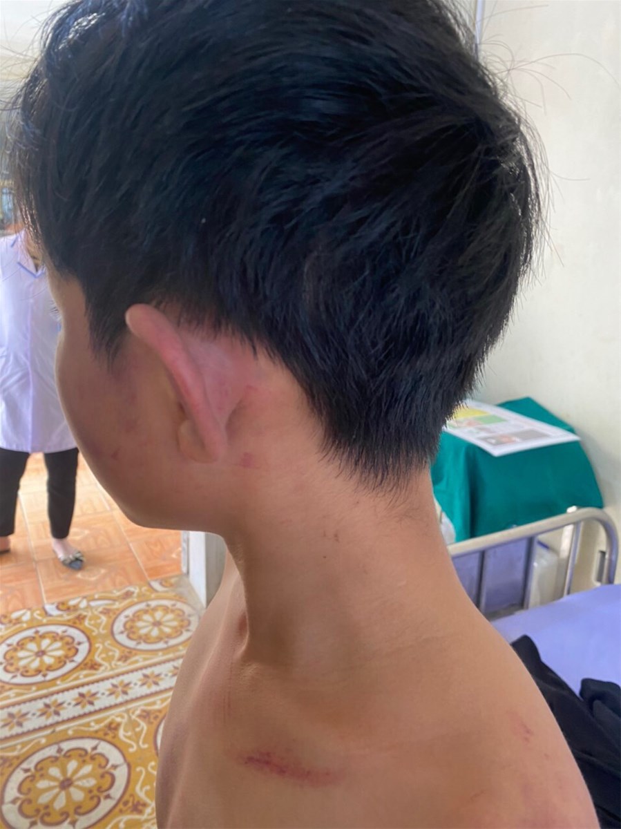 Trường Dân tộc nội trú THCS Lục Yên (Yên Bái): Học sinh bị đánh trong trường, trách nhiệm thuộc về ai?