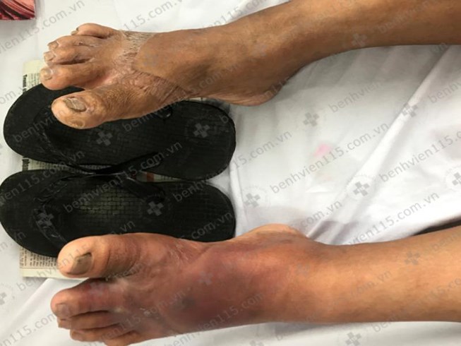 Mang d&eacute;p kẹp người phụ nữ bị nhiễm tr&ugrave;ng b&agrave;n ch&acirc;n nặng
