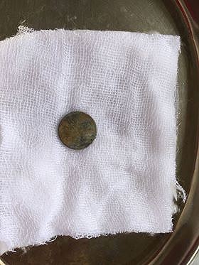 Lạng Sơn: Gắp thành công cục pin đường kính 1,5cm trong thực quản bé 3 tuổi