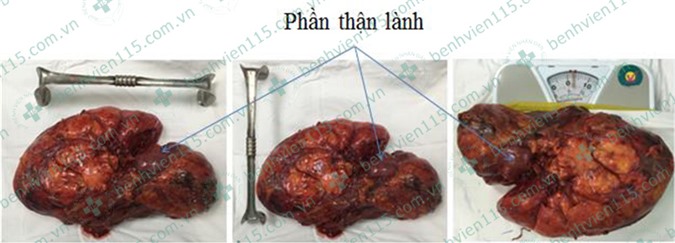 Phẫu thuật cắt u thận “khủng” 3,5kg cho nữ bệnh nhân 49 tuổi