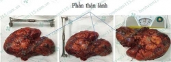 phau thuat cat u than khung 35kg cho nu benh nhan 49 tuoi