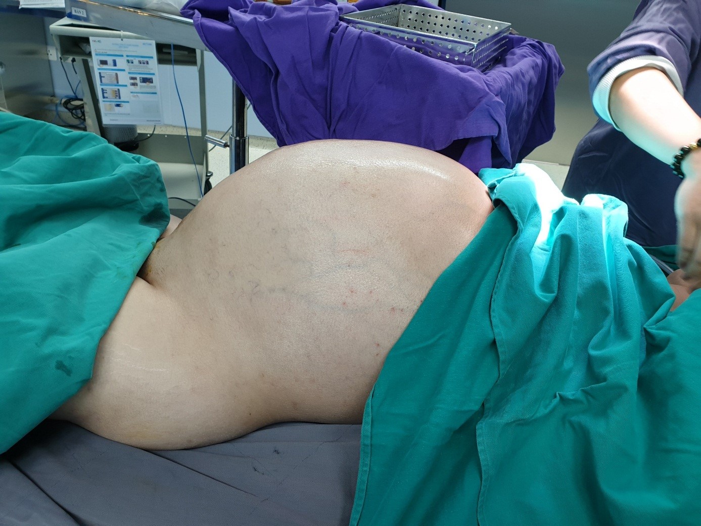 Phẫu thuật lấy khối u khổng lồ 25kg sống chung với bệnh nhân suốt 6 năm