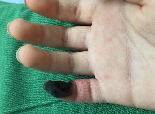 Tự điều trị mụn cóc, một bệnh nhân bị hoại tử ngón tay