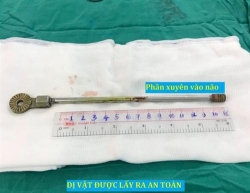 tphcm be trai 5 tuoi bi thanh sat dam xuyen qua hoc mat