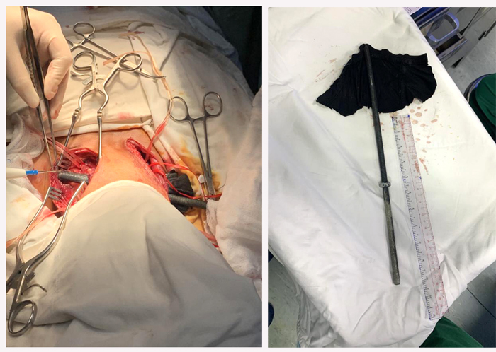 TP.Hồ Ch&iacute; Minh: Cấp cứu th&agrave;nh c&ocirc;ng nam thanh ni&ecirc;n bị thanh sắt đ&ecirc;m xuy&ecirc;n cổ