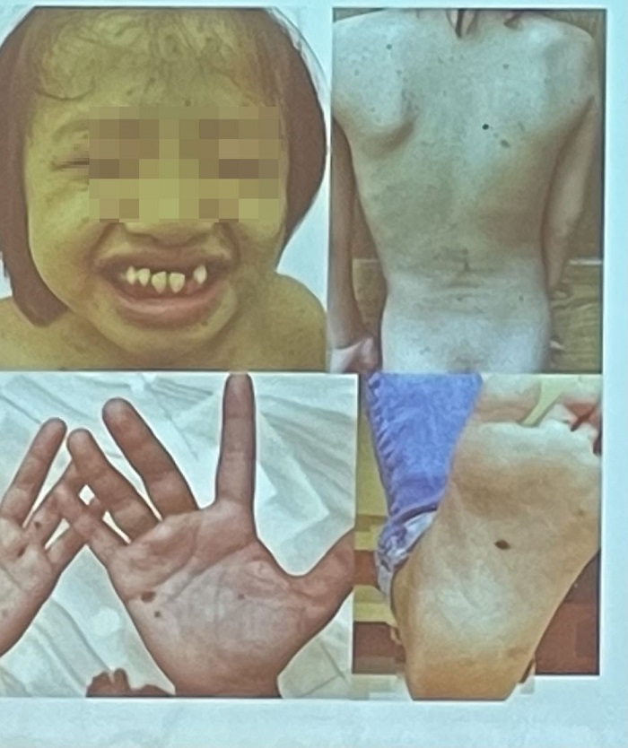 B&eacute; g&aacute;i đầu ti&ecirc;n tại Việt Nam mắc hội chứng da b&aacute;o, ca bệnh 201 tr&ecirc;n thế giới