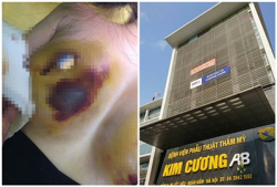 nguoi phu nu nhap vien sau khi bo gan 300 trieu nang nguc tai bv pttm kim cuong ab