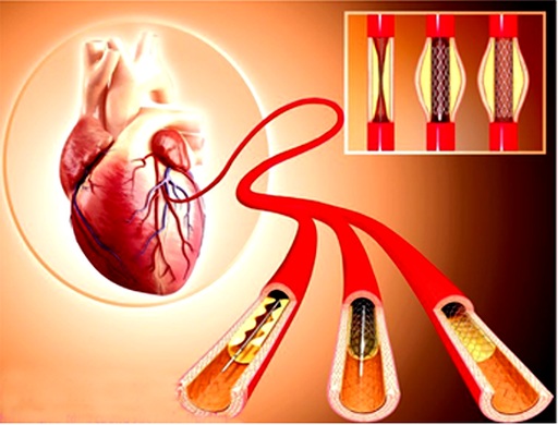 Lợi ích, hiệu quả và an toàn của stent tự tiêu