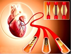 loi ich hieu qua va an toan cua stent tu tieu