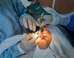 tiep nhan ky thuat cay ghep rang implant
