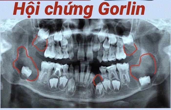 Khánh Hòa: Điều trị thành công cho bệnh nhân nhi mắc hội chứng Gorlin 