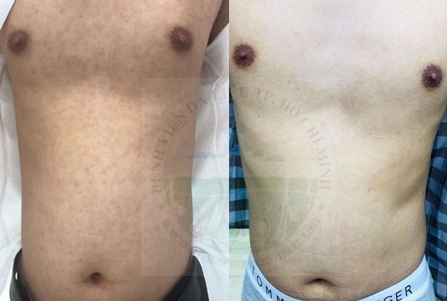 Nam thanh niên mắc bệnh hột xoài hiếm gặp