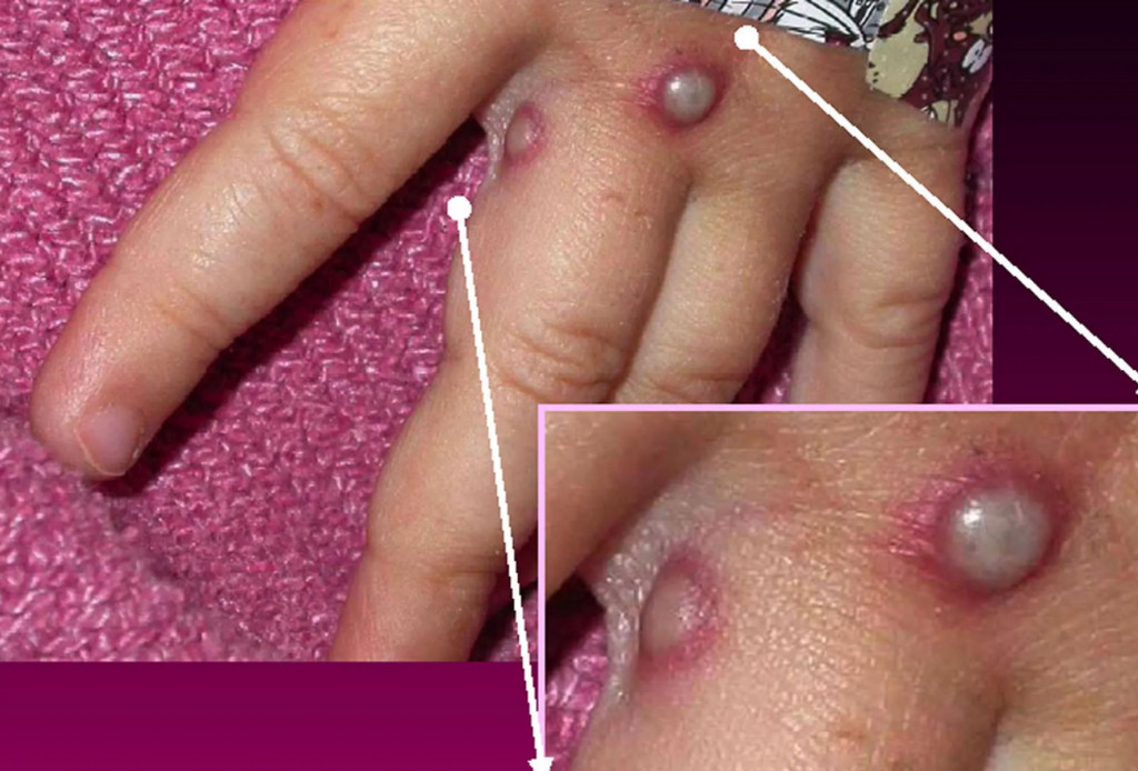 Việt Nam đang giám sát chặt chẽ phòng ngừa bệnh đậu mùa khỉ xâm nhập