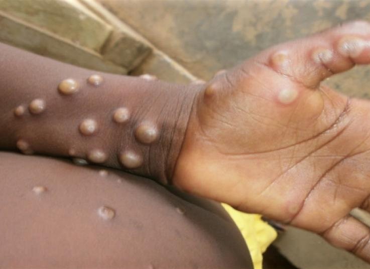 Việt Nam đang giám sát chặt chẽ phòng ngừa bệnh đậu mùa khỉ xâm nhập