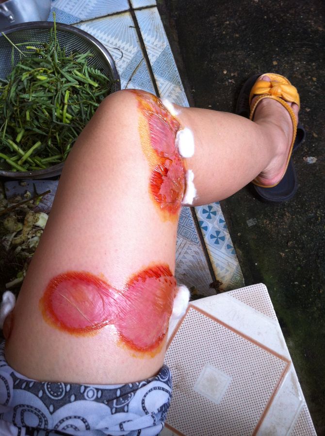 Xuất hiện bọ x&amp;amp;iacute;t h&amp;amp;uacute;t m&amp;amp;aacute;u người tại H&amp;amp;agrave; Nội - Ảnh 2