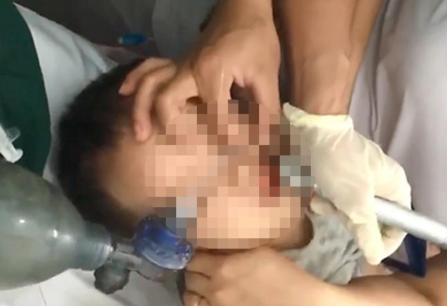 Nghệ An: Cứu sống b&eacute; trai 2 tuổi ngừng thở do h&oacute;c thạch rau c&acirc;u