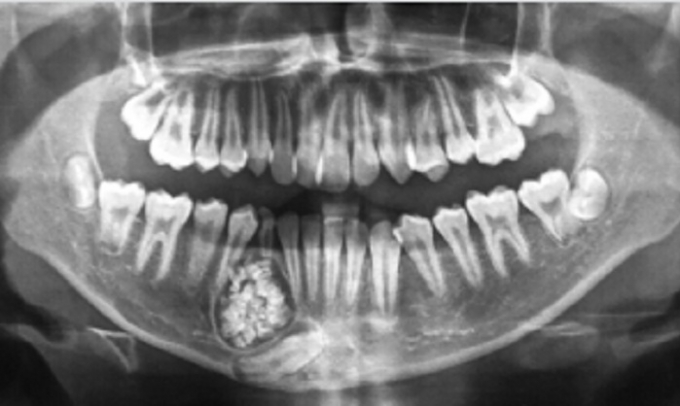 Kh&aacute;nh H&ograve;a: Phẫu thuật lấy gần 100 c&aacute;i răng cho b&eacute; trai 13 tuổi