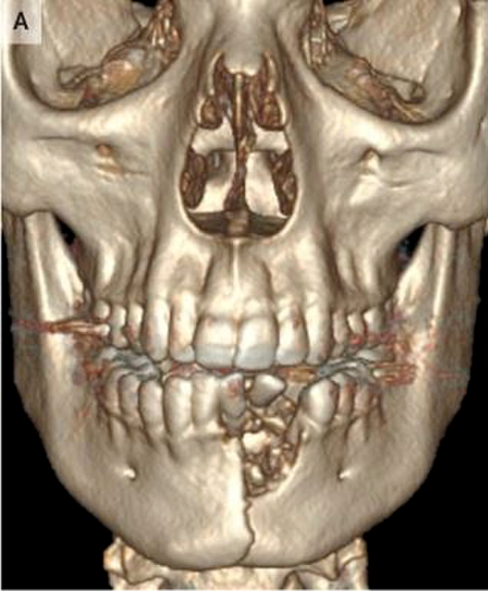 Thuốc l&aacute; điện tử ph&aacute;t nổ , cậu b&eacute; 17 tuổ g&atilde;y đ&ocirc;i xương h&agrave;m