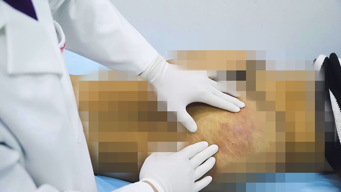 Hoại tử m&ocirc;ng do ti&ecirc;m chất l&agrave;m đầy?