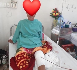 hay can trong khi dap bo thuoc nam sau cac chan thuong