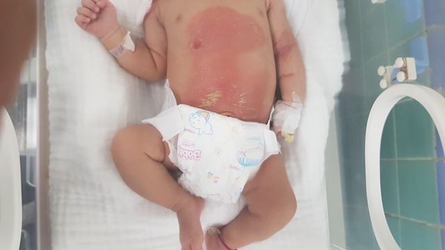 Đắp lá trầu không chữa chướng bụng, bé 14 ngày tuổi bỏng nặng