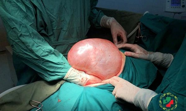 Tuyên Quang: Bác sĩ cắt bỏ thành công khối u “khổng lồ”