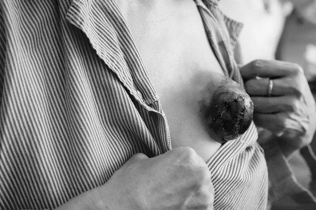 Nhiều bệnh nh&acirc;n bỏ chữa ung thư v&igrave; tin theo quảng c&aacute;o v&ocirc; căn cứ