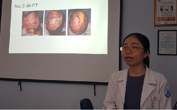 Tóc cuốn vào dây curua, bé gái bị lột gần hết da đầu