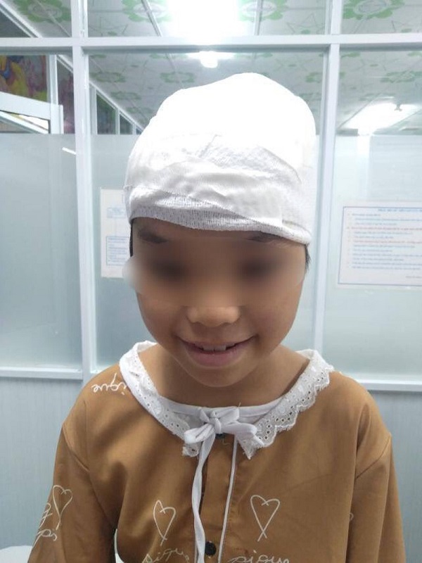 Tóc cuốn vào dây curua, bé gái bị lột gần hết da đầu