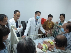 ca song sinh dinh lien se duoc gan 100 bac si phau thuat tach roi vao ngay mai