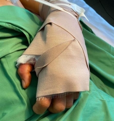 khanh hoa phau thuat thanh cong noi co tay trai bi dut lia cho benh nhan