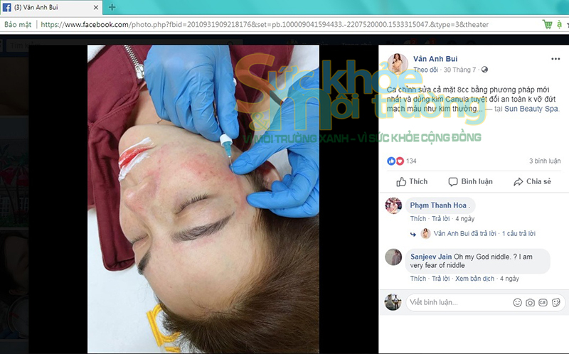 Nghi vấn Sun Beauty Spa thực hiện ti&ecirc;m filler, l&agrave;m đại phẫu tr&aacute;i ph&eacute;p