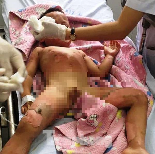 Nhà trẻ dạy kỹ năng phòng chống cháy nổ bằng cồn, 3 trẻ bị bỏng nặng