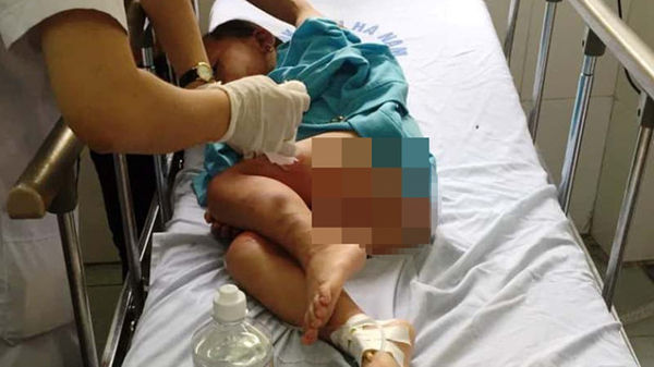 Nhà trẻ dạy kỹ năng phòng chống cháy nổ bằng cồn, 3 trẻ bị bỏng nặng
