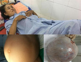 ha tinh benh nhan mang khoi u 10kg thay boi noi co thai