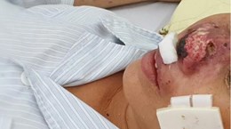Bệnh truyền nhiễm dễ gây tử vong Whitmore tái xuất hiện ở Việt Nam