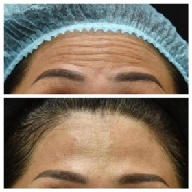 su dung doc to botulinum trong tham my co an toan