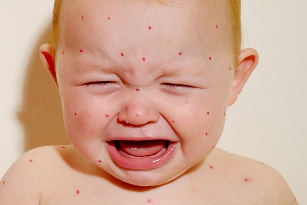 Thống kê trên 40 tỉnh thành đã có 1000 ca mắc bệnh sởi