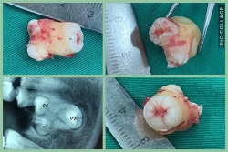 truong hop bat thuong rang sinh ba lan dau tien duoc ghi nhan tai viet nam