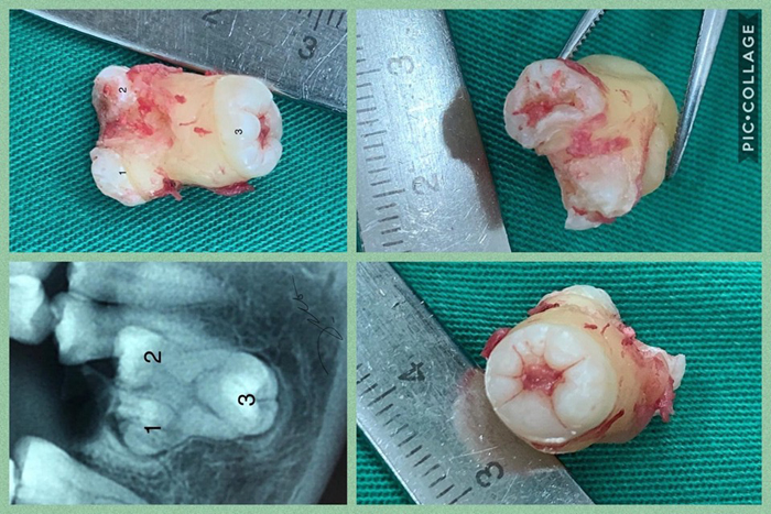 Trường hợp bất thường răng sinh ba, lần đầu tiên đuợc ghi nhận tại Việt Nam