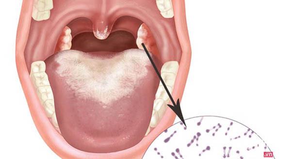 Phát hiện thêm 2 ca nghi nhiễm bạch hầu ở Quảng Nam