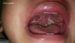 phat hien them 2 ca nghi nhiem bach hau o quang nam