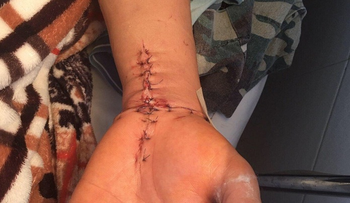 Phẫu thuật nối thành công bàn tay bị đứt lìa cho bệnh nhân