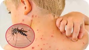 Số ca tử vong tăng, TP HCM phân tầng điều trị sốt xuất huyết