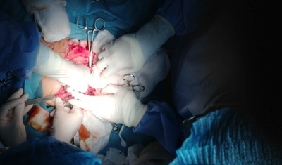 Tách rời thành công 2 em bé dính liền tim, gan ở Sài Gòn