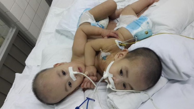 Tách rời thành công 2 em bé dính liền tim, gan ở Sài Gòn